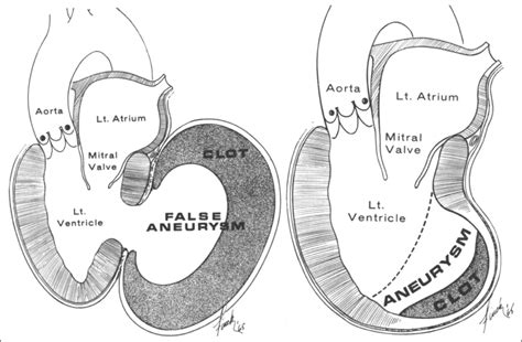 pseudoaneurysm vs true aneurysm echo